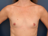 Breast Implants