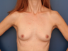 Breast Implants
