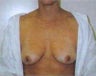 Breast Augmentation