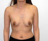 Breast Augmentation
