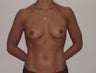 Breast Augmentation