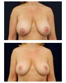 Breast Augmentation with Lift