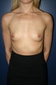Breast Augmentation