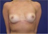 Breast Implants