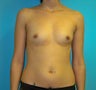 Breast Augmentation