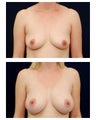 Breast Augmentation