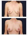 Breast Augmentation