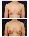Breast Augmentation