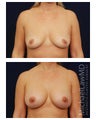 Breast Augmentation