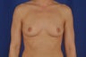 Breast Implants