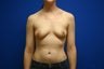 Breast Implants