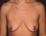 Breast Enlargement