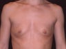 Breast Augmentation