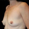 Breast Augmentation