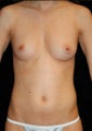 Breast Augmentation 
