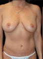 Breast Augmentation