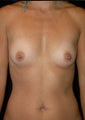 Breast Augmentation