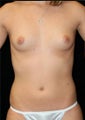 Breast Augmentation