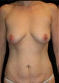 Breast Augmentation & Tummy Tuck