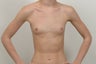 Breast Augmentation