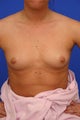 Breast Augmentation