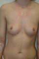 Breast Augmentation