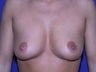 Breast Augmentation