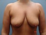 Submuscular Breast Augmentation with Lollipop Mastopexy