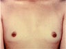 Breast Augmentation