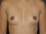 Breast Augmentation