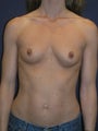 breast augmentation