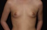 Breast Implants