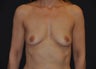 Breast Augmentation