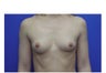 Breast Augmentation