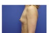 Breast Augmentation