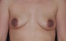 Breast Augmentation
