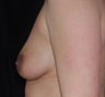 Breast Augmentation