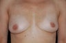 Breast Augmentation