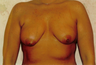 Breast Implants