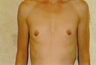 Breast Implants