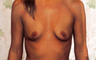 Breast Implants