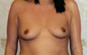 Breast Implants