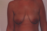 Breast Implants