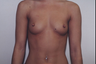 Breast Implants