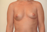Breast Implants