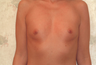 Breast Implants