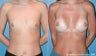Breast Augmentation