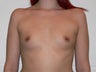 Breast Augmentation (armpit approach)