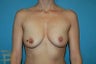 Breast Augmentation
