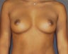 Breast Augmentation